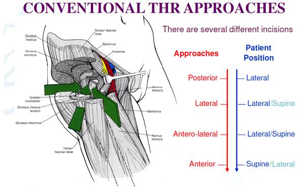 conventional hip replacement surgery